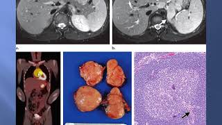 solid tumors of the peritoneum omentum and mesentery [upl. by Noinatrad]