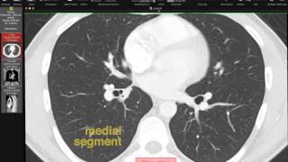 Lobar and Segmental Lung Anatomy on CT [upl. by Schlesinger]