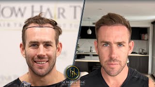 Hair Transplant Before and After  Hair Transplant Results [upl. by Aneev]