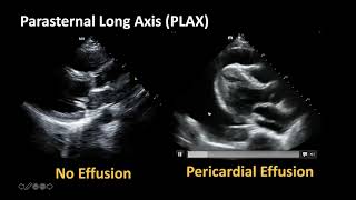 Cardiac Ultrasound Basic Pathology [upl. by Kata]