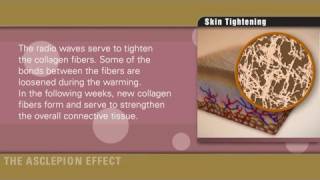 Skin tightening with radiofrequency of Effect systems by Asclepion [upl. by Riabuz]