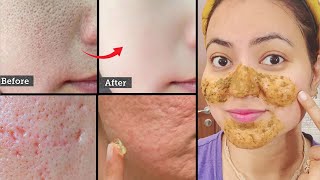 7 Days Challenge  Get Rid of OPEN PORES LARGE PORES CLOGGED PORES Permanently in 7 Days💕 [upl. by Azilef722]