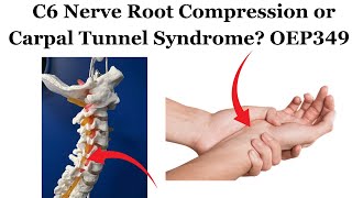 C6 Nerve Root Compression or Carpal Tunnel Syndrome  OEP349 [upl. by Nylavad]