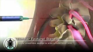 Lumbar Epidural Steroid Injection [upl. by Iolenta]