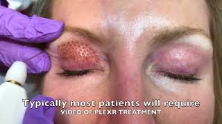 PLEXR PLASMA Eyelid Blepharoplasty [upl. by Atteroc]