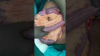 crohn disease  small bowel stricture small bowel resection anatomosis [upl. by Sokem503]