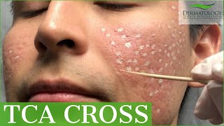 Acne Scar Removal with TCA Cross 80  Los Angeles  Dr Ben Behnam [upl. by Schwenk]