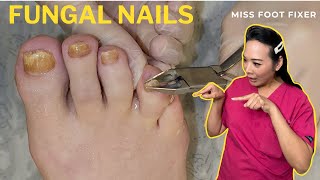 Complete Fungal Nail Treatment A StepByStep Guide  Miss Foot Fixer [upl. by Thrift]