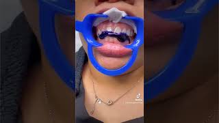 Does Purple Toothpaste Actually Work LaserGlow Toothpaste Review purpletoothpaste teethwhitening [upl. by Edurtreg]