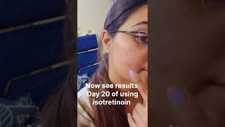 Acne prone skin treatment 🥹🔥 acnetreatment acneproneskin isotretinoin acnecare trending [upl. by Dorothy]