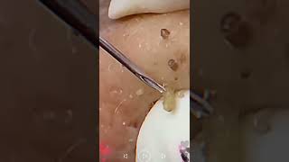 Skincare  Blackheads Removal 182 skincare skincare blackheads blackheads [upl. by Yniffit]