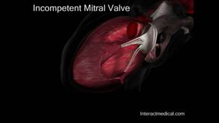 Mitral Valve normal and incompetent [upl. by Petronia]