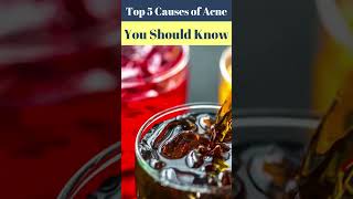 Top 5 Causes of Acne You Should Know – Dr Atif Kazmi Explains [upl. by Drofnelg]