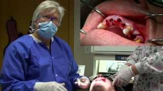 Physics Forceps Immediate Implant Placement Grafting tooth extraction overdenture [upl. by Elimay374]