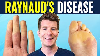 Doctor explains Raynauds disease and syndrome  Causes prevention and treatment [upl. by Nitsrek]