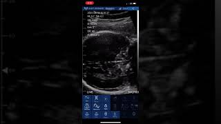 Five month fetus ultrasound with the EagleView probe [upl. by Marutani]