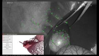 SLAM based Quasi Dense Reconstruction For Minimally Invasive Surgery Scenes Private Dataset [upl. by Ennove]