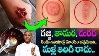 Best Natural Home Remedies For RINGWORM TREATMENTS  Dr Manthena Satyanarayana  GOOD HEALTH [upl. by Sanger]