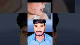 How to remove pimple short pimple acnestar [upl. by Eimorej]