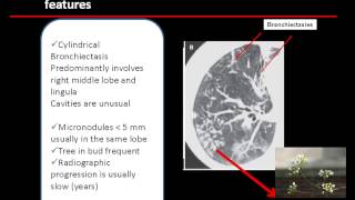 Criteria for defining environmental mycobacteria disease [upl. by Allys]