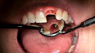 Central Incisor Implant Impression [upl. by Mortimer]