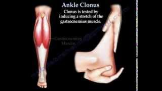 Ankle Clonus  Everything You Need To Know  Dr Nabil Ebraheim [upl. by Artinek930]