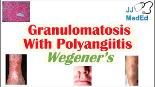 Granulomatosis with Polyangiitis Wegener’s granulomatosis  Symptoms Diagnosis Treatment [upl. by Granniah]