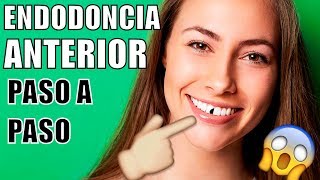 ENDODONCIA EN EL DIENTE DELANTERO ME ROMPÍ UN DIENTE COMO ES UNA ENDODONCIA COMO MTAR EL NERVIO [upl. by Aynatan]