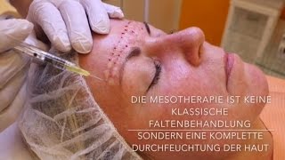 Mesotherapie mit Hyaluronsäure  Behandlung Vorher Nachher [upl. by Perkin]