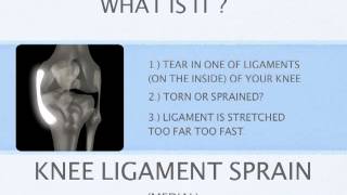 Knee Ligament Sprain [upl. by Arri]