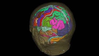 Cavernoma parietal [upl. by Dominick150]