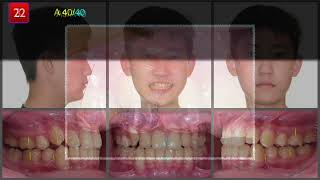 Treatment of impacted maxillary canine with Invisalign｜【Chris Chang Ortho】CC767 [upl. by Premer798]