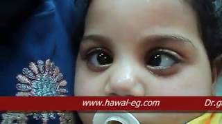 Nystagmus Blockage Syndrome  الرأرأة  العيون الراقصة [upl. by Fasta88]