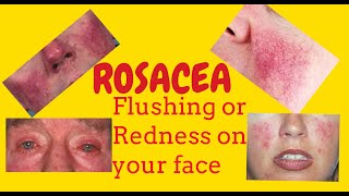 Rosacea or Potato nose or Rhinophyma or Redness of the face Phymatous rosacea Telangiectasia [upl. by Odnamla445]