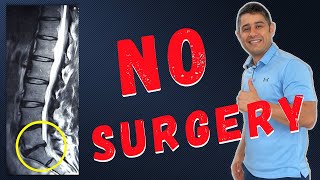 Lumbar Disc Bulges L5 S1 recovery without surgery [upl. by Arrik]