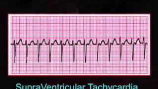 Introduction to EKG Rhythm Interpretation Part 3 [upl. by Nojid]