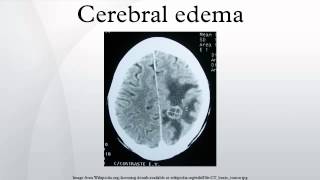 Cerebral edema [upl. by Arria]