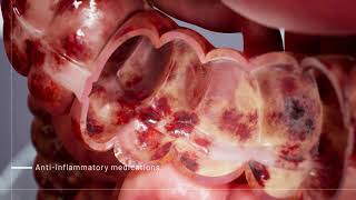 Ulcerative Colitis Medications  3D Medical Animation  Pixeldust Studios [upl. by Bale306]