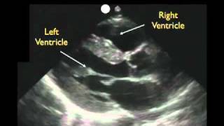 Cardiac Ultrasound  Parasternal Long Axis  Part 1  Sonosite Inc [upl. by Osmo]