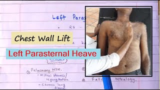 Clinical Sign Of Right Ventricular Hypertrophy  Left Parasternal Heave How To Palpate [upl. by Pietra]