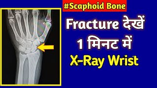 Fracture Scaphoid Bone  XRay Wrist  UdayXRay [upl. by Cassell]