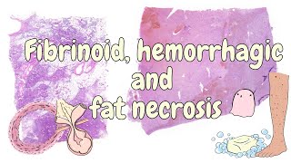 Fibrinoid hemorrhagic and fat necrosis  general pathology [upl. by Buschi444]