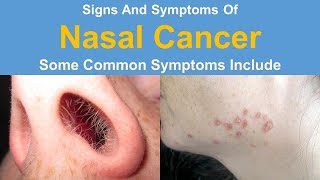 Signs And Symptoms Of Nasal Cancer [upl. by Dorreg385]