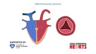 Pulmonary Stenosis [upl. by Nahgrom765]