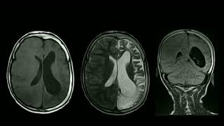 CASE  2 DYKEDAVIDOFFMASSON SYNDROME [upl. by Carney]