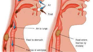 Aspiration Pneumonia [upl. by Kalmick]