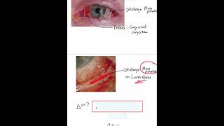 Acute Bacterial Conjunctivitis  Case Discussion In A Minute Shorts [upl. by Hamal]