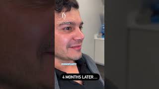 Facial Contour Enhancement Dr Samans Technique nosesurgery fattransfer facialcosmeticsurgery [upl. by Karab866]