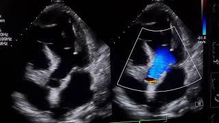 RWMAModerate LV DysfunctionTrace pericardial effusionpleural effusion cardioheartcondition [upl. by Chan237]