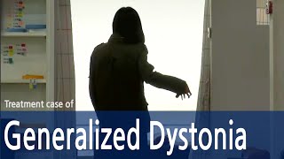 Generalized DystoniaDystoniaCervical dystoniaSpasmodic Torticollis  전신 사경증  근긴장이상증 [upl. by Ros]